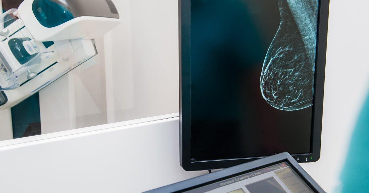 New study sheds light on how to screen for breast cancer |